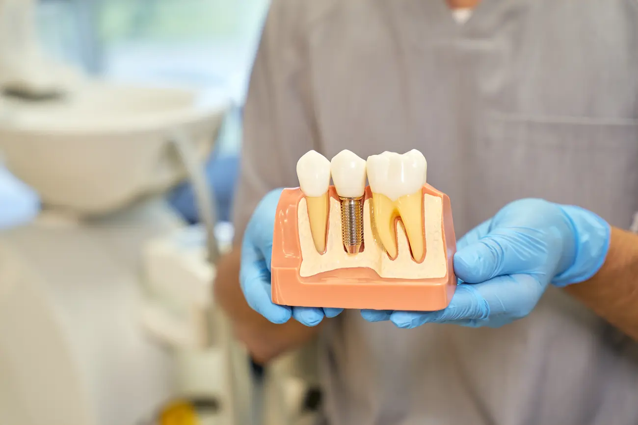 cropped shot of dental implant model in hands of d 2025 03 14 01 53 28 utc
